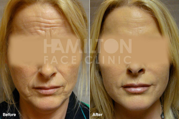 Before and after photo